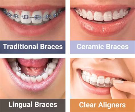 metal and ceramic brackets|are ceramic braces more expensive.